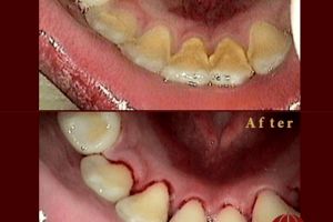 آیا جرم گیری دندان کودکان عوارض دارد ؟