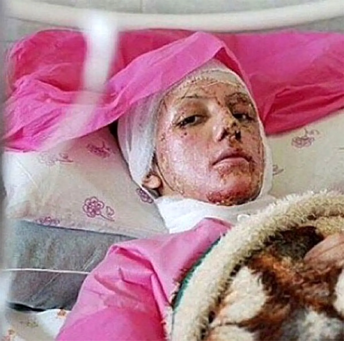 محکومیت 3 فرماندار در رابطه با تخلفات انتخاباتی/ قربانیان اسیدپاشی اصفهان دیه دریافت می‌کنند