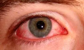 کرونا از چشم و گوش وارد بدن می‌شود؟