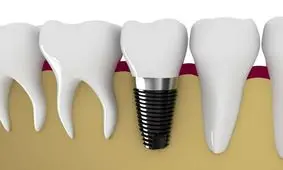 ایمپلنت دندان چیست؟