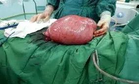 خارج کردن توده ۱۵ کیلویی از شکم بیمار در شهرستان صحنه