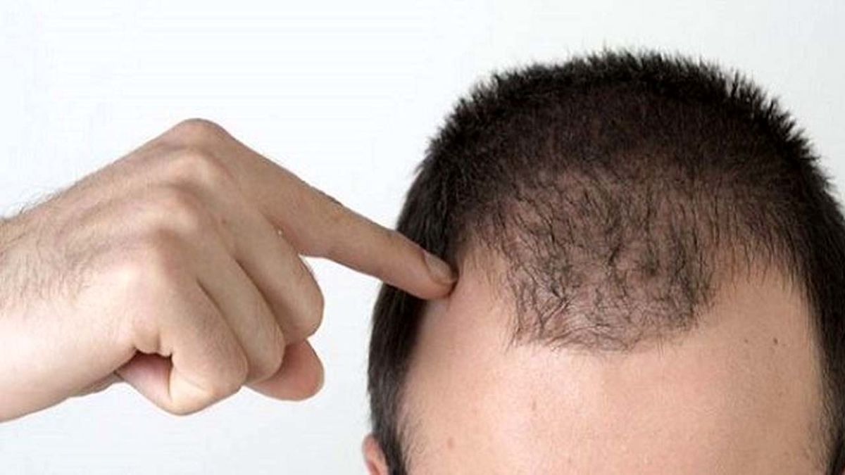 علت ریزش مو در افراد مبتلا به کرونا