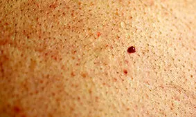  آن چه باید درباره خال‌های قرمز بدانید