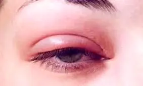 درمان خانگی گلمژه چگونه است؟/ ویدئو