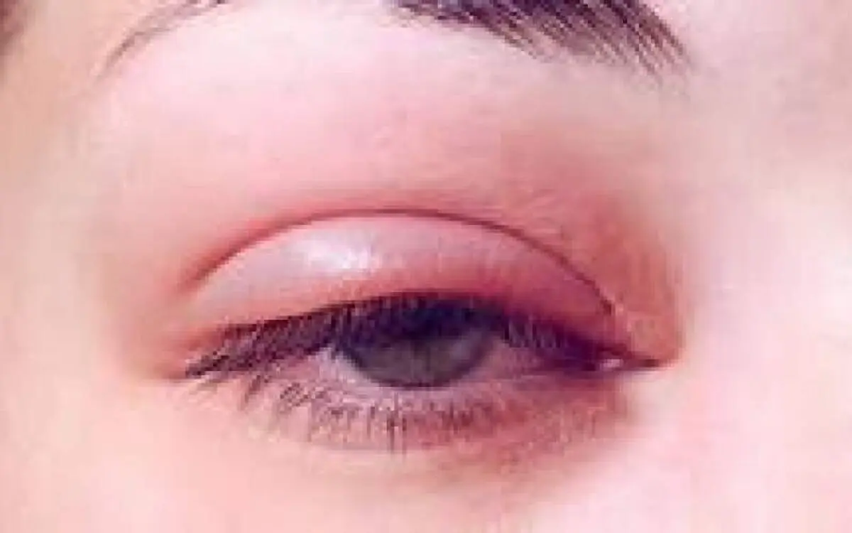 درمان خانگی گلمژه چگونه است؟/ ویدئو
