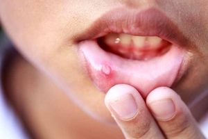 کمبود کدام ویتامین باعث آفت دهان می‌شود؟