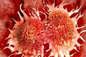 کم‌خونی مردان بالای ۴۰ سال نشانه کدام سرطان است؟