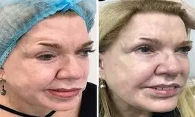 تزریق بوتاکس، نقص ۱۹ ساله صورت یک زن را اصلاح کرد/ تصاویر