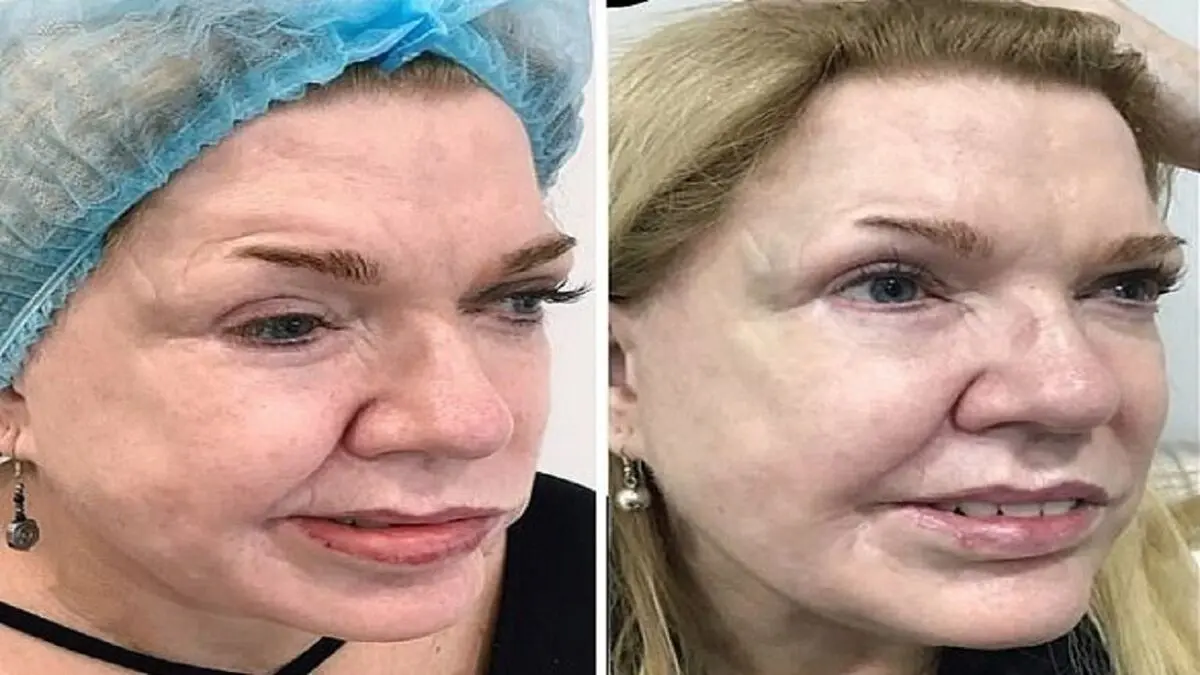 تزریق بوتاکس، نقص ۱۹ ساله صورت یک زن را اصلاح کرد/ تصاویر