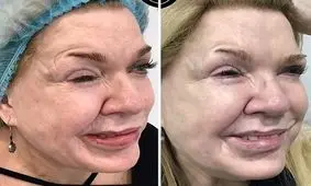 تزریق بوتاکس نقص ۱۹ ساله صورت یک زن را اصلاح کرد/ تصویر