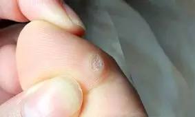 روش‌های گوناگون درمان میخچه