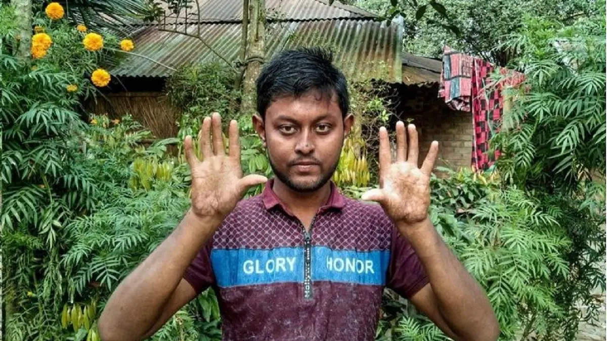 خانواده ای که اعضای آن اثر انگشت ندارند!