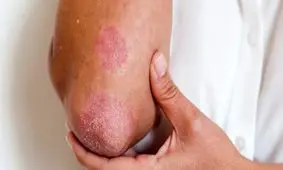 پسوریازیس؛ از انواع تا جلوگیری از تشدید