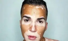 اتفاق ساده ای که زندگی مدل مبتلا به بیماری پوستی را تغییر داد!