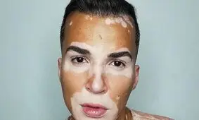 اتفاق ساده ای که زندگی مدل مبتلا به بیماری پوستی را تغییر داد!