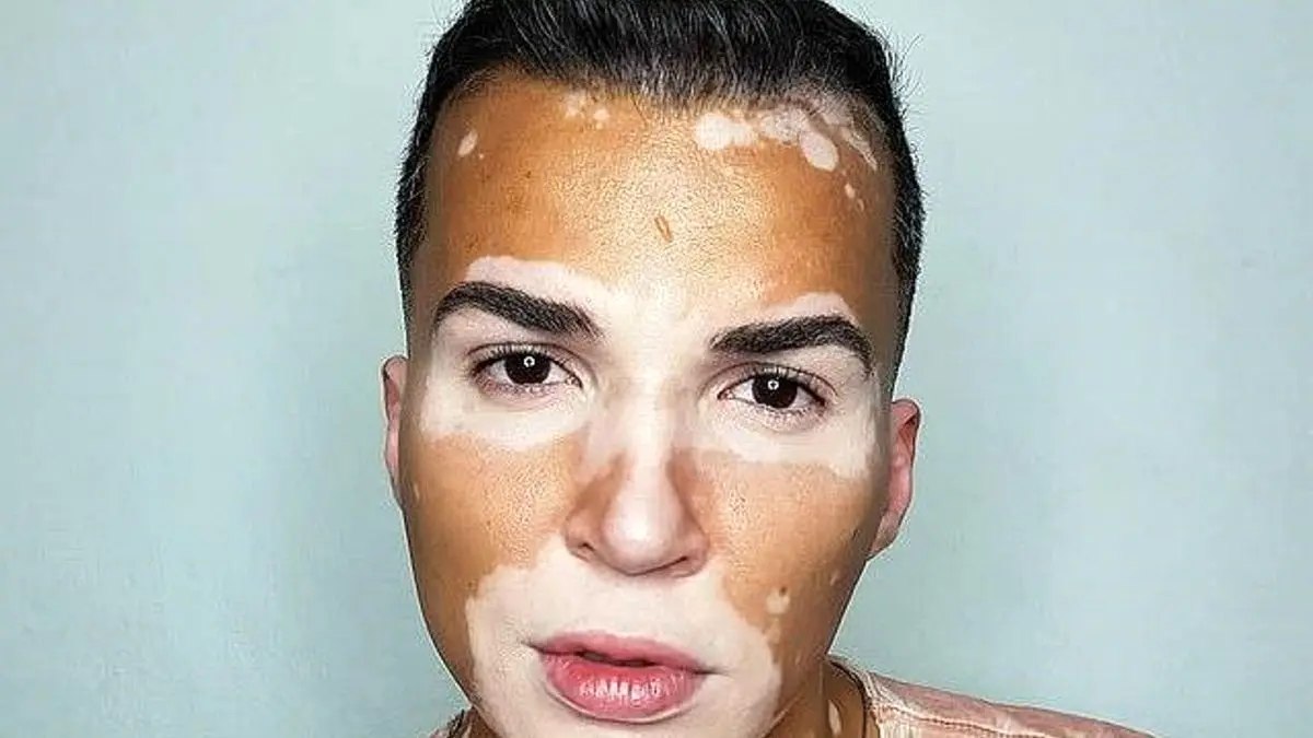 اتفاق ساده ای که زندگی مدل مبتلا به بیماری پوستی را تغییر داد!