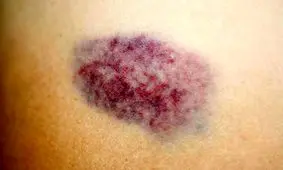 علت کبودی‌های بی دلیل چیست؟