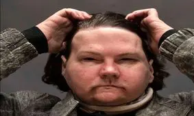 زندگی دوباره مرد خوش‌شانس با چهره و دست‌های جدید!