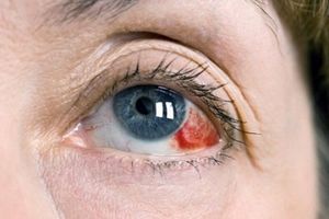 لکه های قرمز داخل چشم چه رازهایی درباره سلامت شما دارند؟