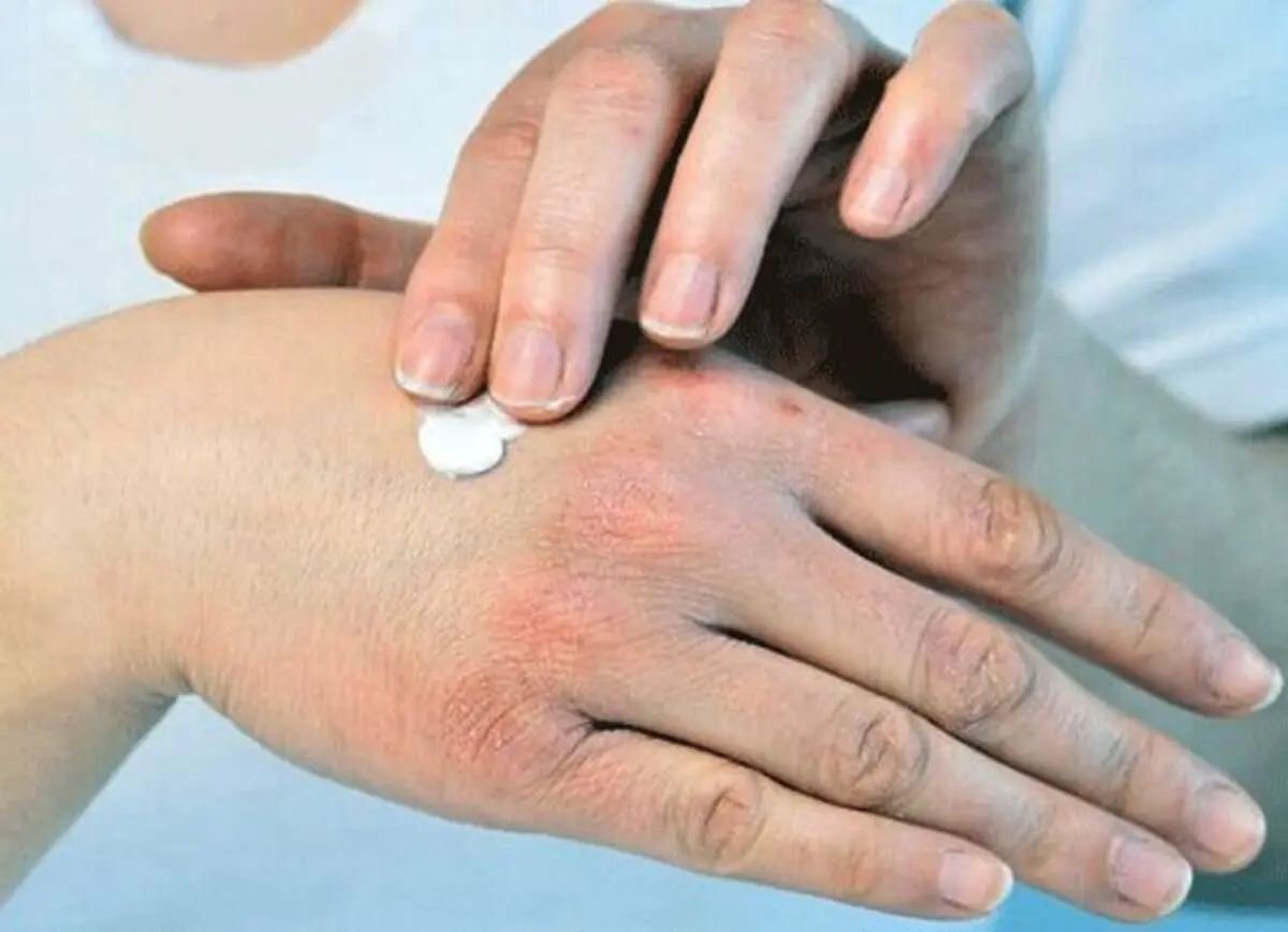 چند توصیه برای کاهش خشکی پوست