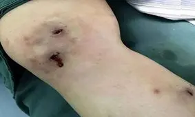 زایمان مگس زیر پوست پای دختر جوان