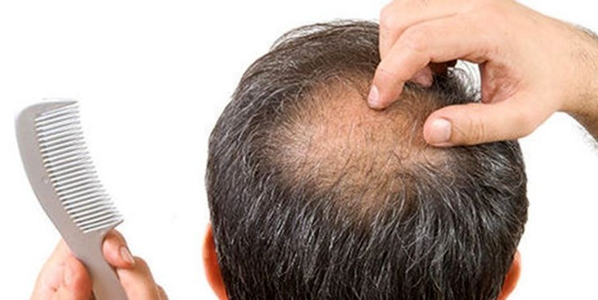 ریزش مو؛ عارضه طولانیمدت ابتلا به کرونا