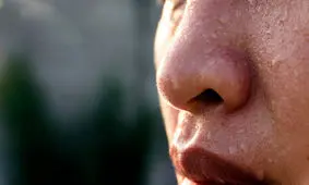 عرق کردن شدید صورت و رهایی از آن