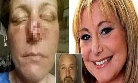 مرد خشمگین با دندان، بینی نامزد سابقش را کند