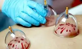 بهار، بهترین زمان برای کاهش «هیجان خون» است/ چاق ها و لاغرها! حجامت نکنید