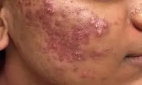 داشتن پوست شاداب و سالم با اجتناب از این ۶ ماده غذایی