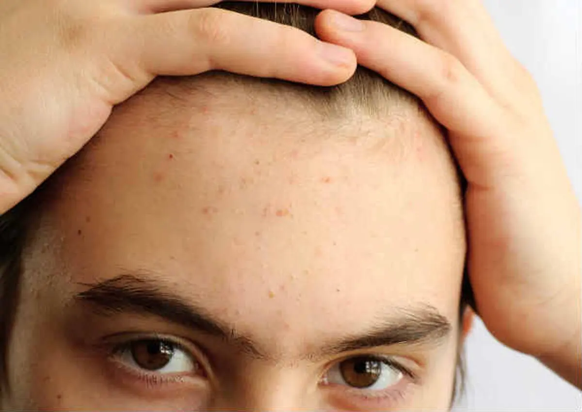 زخم‌های عفونی رد بیشتری از خود بجا می‌گذارند؟/ ویدئو