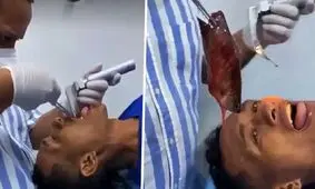 بیرون کشیدن ماهی ۱۷ سانتیمتری از گلوی ماهیگیر کلمبیایی!/ ویدئو