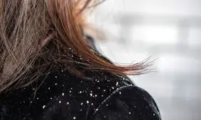 چه زمانی شوره سر نگران کننده است؟/ ویدئو