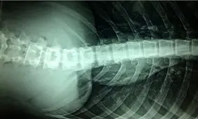 روش جدیدی برای بهبود پس از آسیب نخاعی