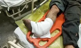 موادمحترقه باعث قطع پای مرد ساوجی شد