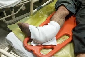 موادمحترقه باعث قطع پای مرد ساوجی شد