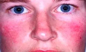 آنچه که از لکه‌های سمج پوستی یا بیماری رزاسه نمی‌دانید