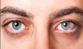 آب سیاه و آب مروارید چه شباهتی با یکدیگر دارند؟