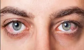 آب سیاه و آب مروارید چه شباهتی با یکدیگر دارند؟