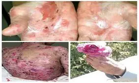 روایت پروانه‌ای‌ها از سختی‌های زندگی/می‌خواستند از مدرسه اخراجمان کنند؛ نمی دانستند واگیر نداریم/ هزینه‌های درمان زیاد است؛ حتی نمی توانیم جراحی کنیم