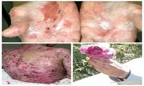 روایت پروانه‌ای‌ها از سختی‌های زندگی/می‌خواستند از مدرسه اخراجمان کنند؛ نمی دانستند واگیر نداریم/ هزینه‌های درمان زیاد است؛ حتی نمی توانیم جراحی کنیم