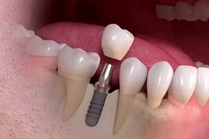 ایمپلنت دندان چیست؟/ ویدئو