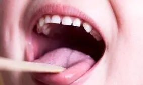 شایع‌ترین علامت ابتلا به سرطان دهان و زبان