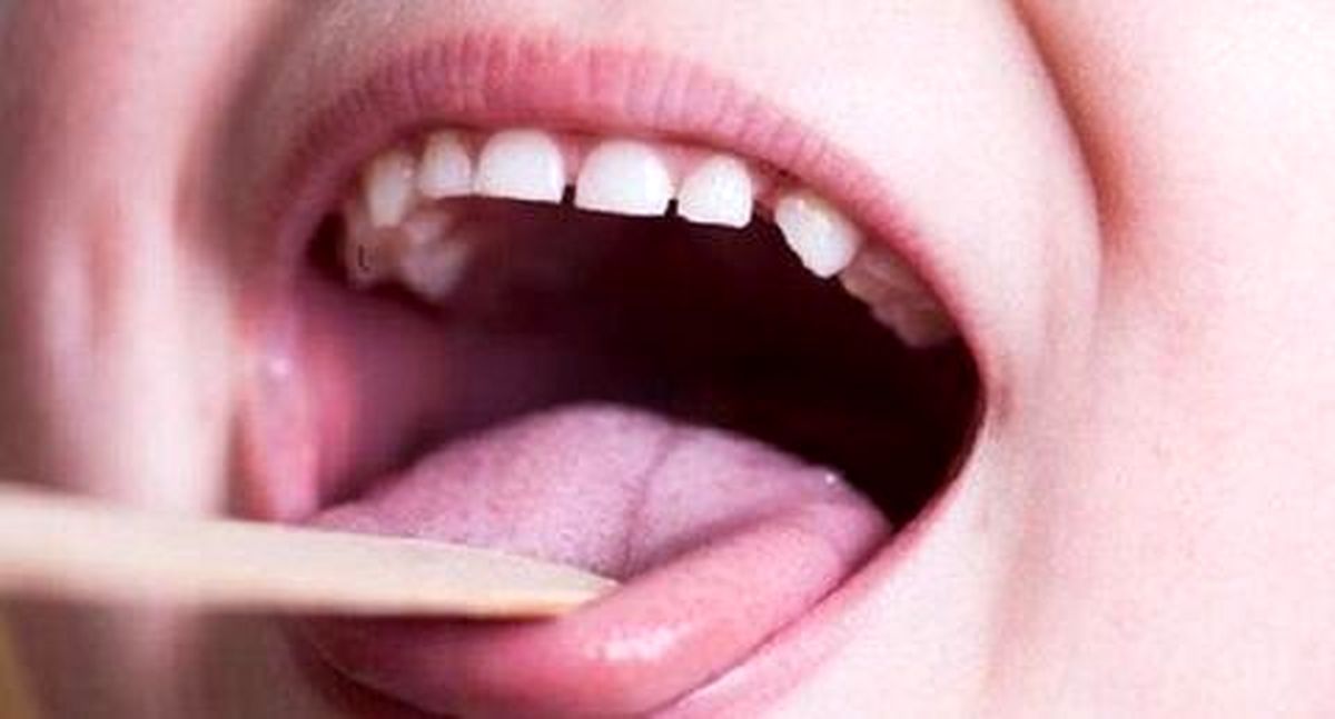 شایعترین علامت ابتلا به سرطان دهان و زبان