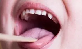 شایع‌ترین علامت ابتلا به سرطان دهان و زبان