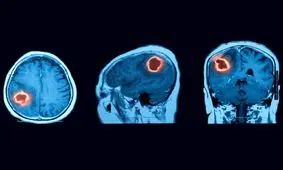 موفقیت در درمان تومورهای بدخیم مغز با نانوحامل