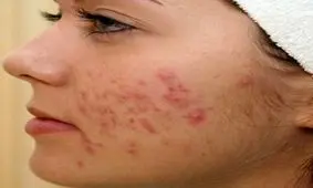 جای جوش را چگونه می توان از بین برد؟