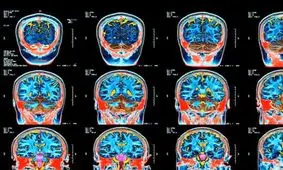 اختلال اسرارآمیز مغزی که باعث توهم و خرد شدن دندان‌ها می‌شود