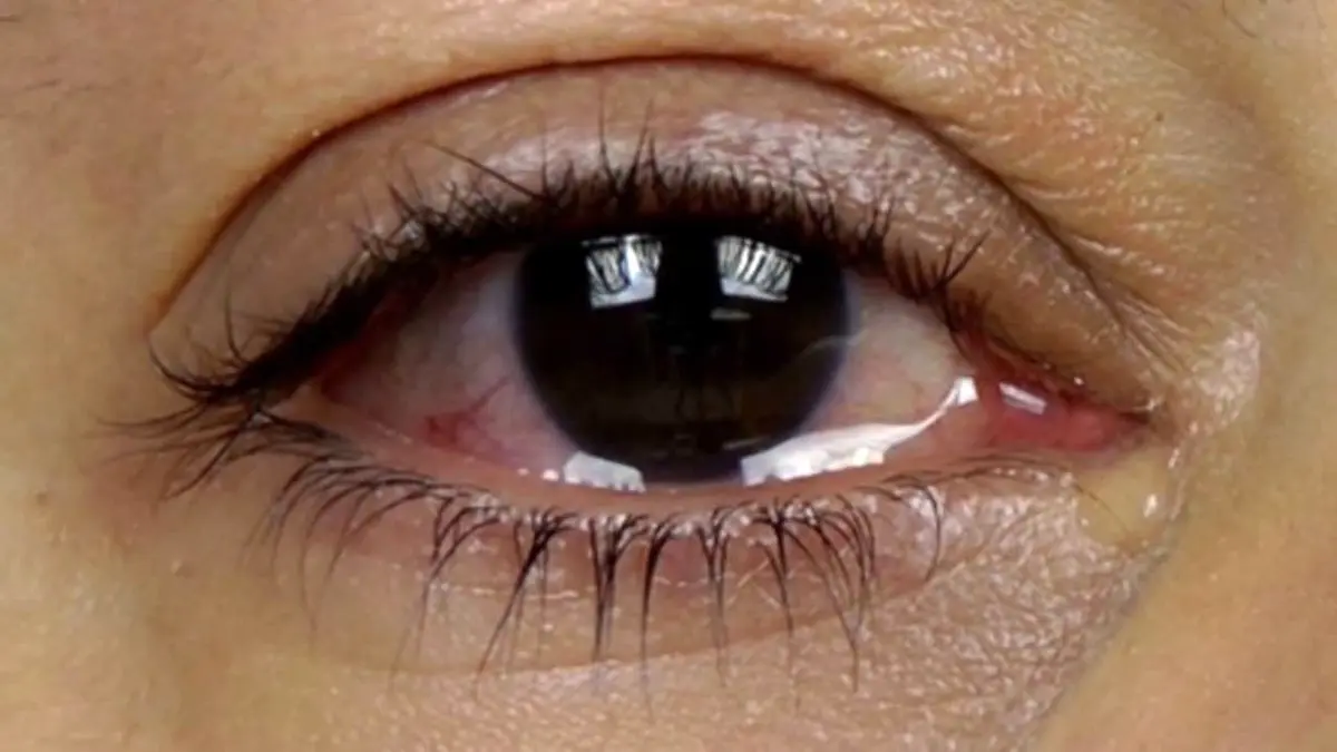 چشم؛‌ دریچه‌ای برای تشخیص بسیاری از بیماری‌ها