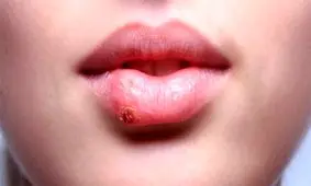 نکاتی درباره عامل انتقال تبخال